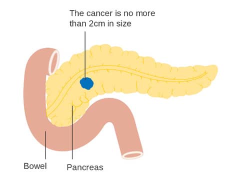 البنكرياس،سرطان،صورة