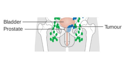 البروستاتا،prostate،صورة