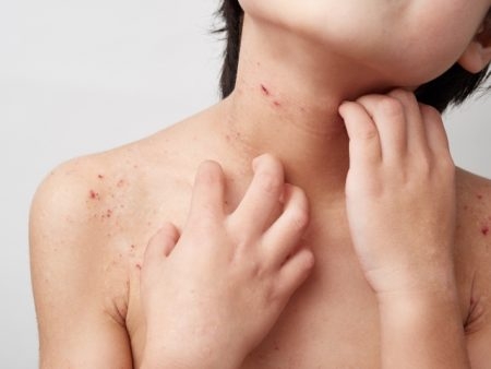 صورة , طفل , مريض , حساسية الجلد عند الأطفال