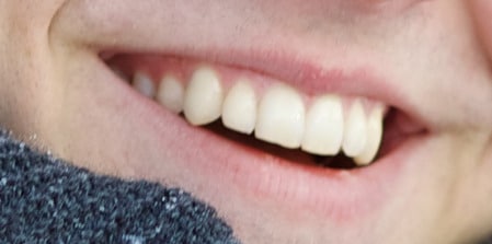 الأسنان،teeth،صورة