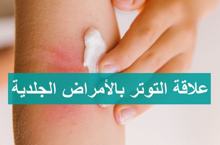 علاقة التوتر النفسي بالأمراض الجلدية .. وأحدث علاجات حب الشباب