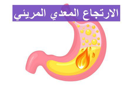 أسباب الارتجاع المعدي المريئي وتشخيصه