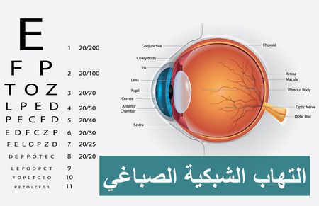 التهاب الشبكية الصباغي