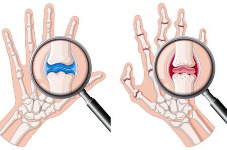 التهاب المفاصل الروماتويدي