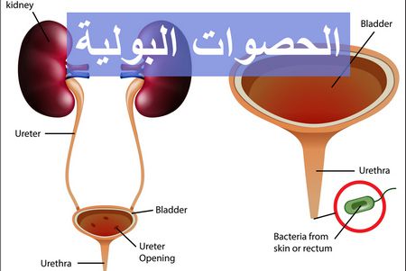 أسباب وأعراض الحصوات البولية .. 5 معلومات في الصميم