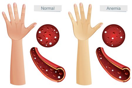 فقر الدم