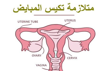 متلازمة تكيس المبايض