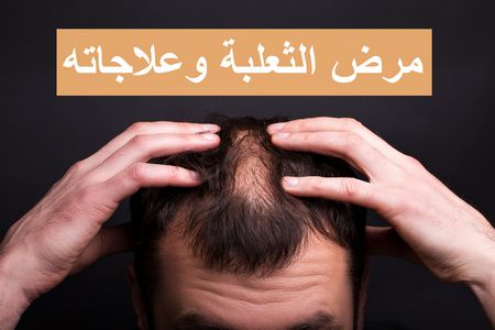 مرض الثعلبة