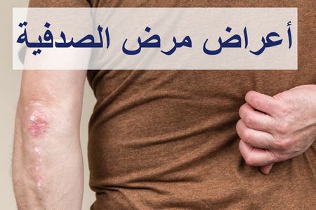 أسباب وأعراض مرض الصدفية والأشخاص الأكثر عرضة للإصابة به