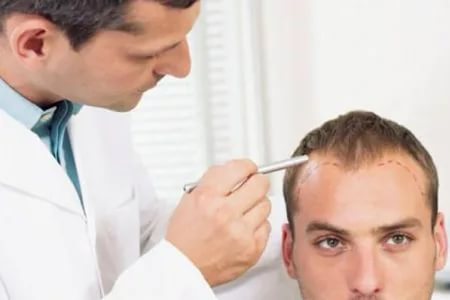 معلومات عن زراعة الشعر وآثاره الجانبية