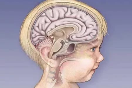 معلومات عن ضمور المخ عند الاطفال